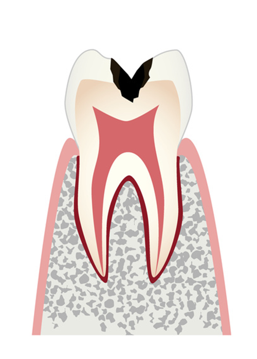 歯の内部まで進行したムシ歯